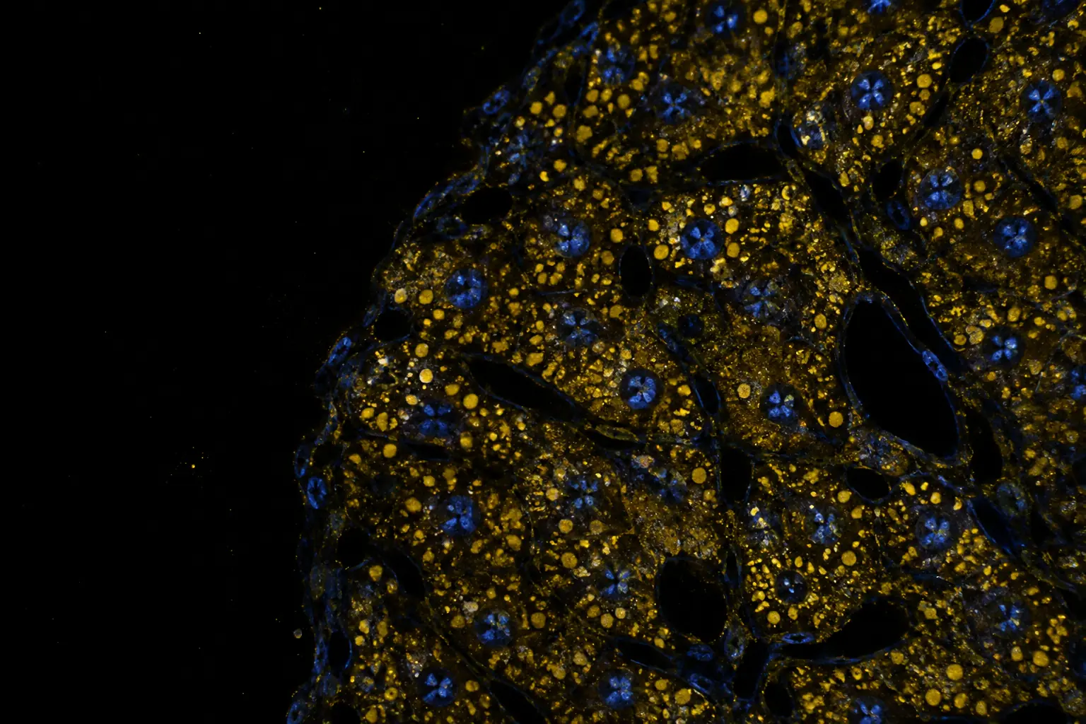Fluorescence micrograph: liver tissue with many small golden lipid droplets inside the hepatocytes